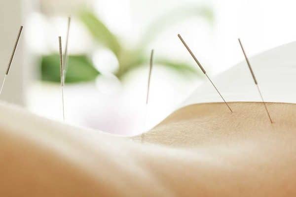 photo of acupuncture needles in a person's back
